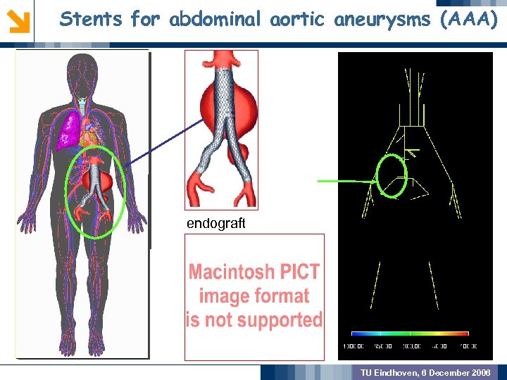 Stents for abdominal aortic aneurysms (AAA) GEOMETRIC PREPROCSSING MODEL VALIDATION endograft OUTCOME TU Eindhoven,