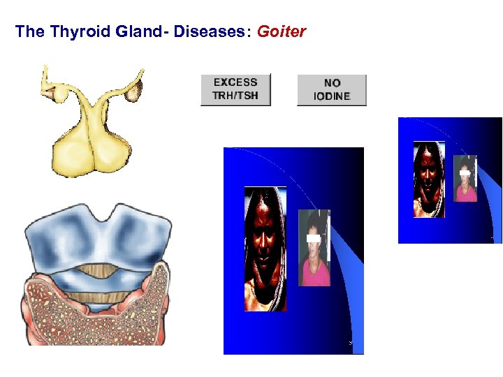 The Thyroid Gland- Diseases: Goiter 