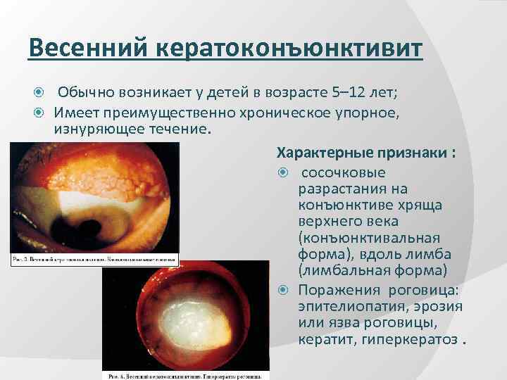 Весенний кератоконъюнктивит Обычно возникает у детей в возрасте 5– 12 лет; Имеет преимущественно хроническое