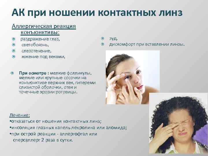 АК при ношении контактных линз Аллергическая реакция конъюнктивы: раздражение глаз, светобоязнь, слезотечение, жжение под