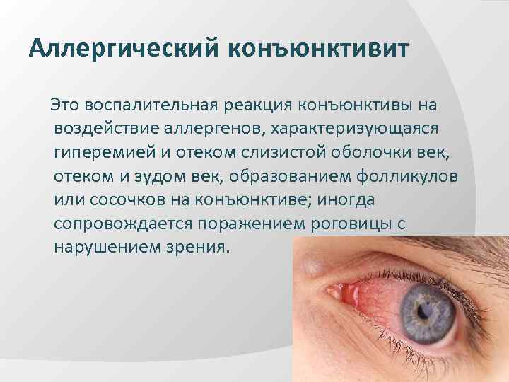 Аллергический конъюнктивит Это воспалительная реакция конъюнктивы на воздействие аллергенов, характеризующаяся гиперемией и отеком слизистой
