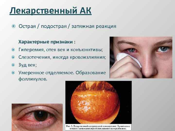 Лекарственный АК Острая / подострая / затяжная реакция Характерные признаки : Гиперемия, отек век