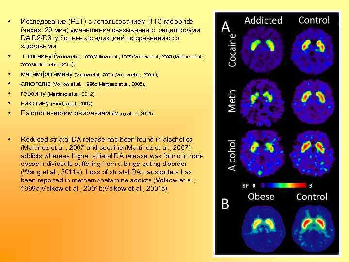  • • Исследование (PET) с использованием [11 C]raclopride (через 20 мин) уменьшение связывания