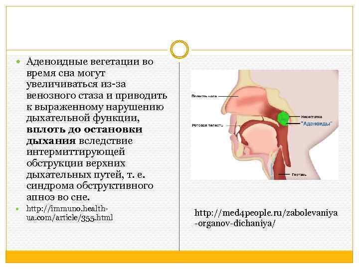  Аденоидные вегетации во время сна могут увеличиваться из-за венозного стаза и приводить к