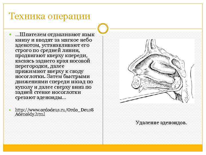 Техника операции …Шпателем отдавливают язык книзу и вводят за мягкое небо аденотом, устанавливают его