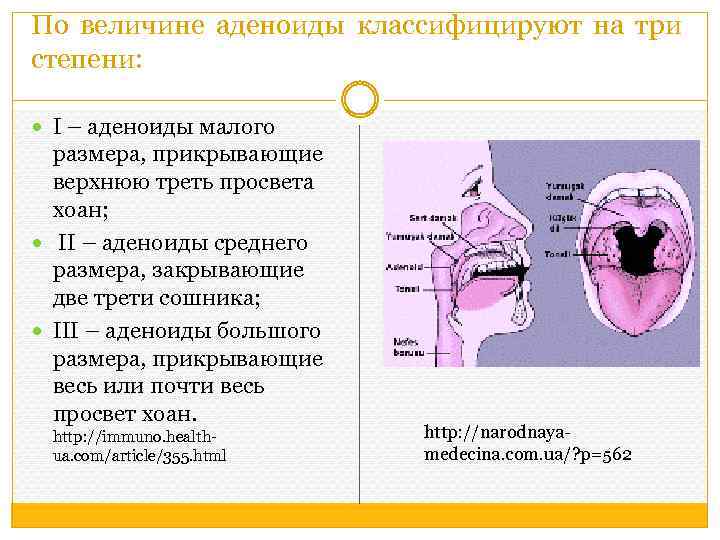 По величине аденоиды классифицируют на три степени: I – аденоиды малого размера, прикрывающие верхнюю