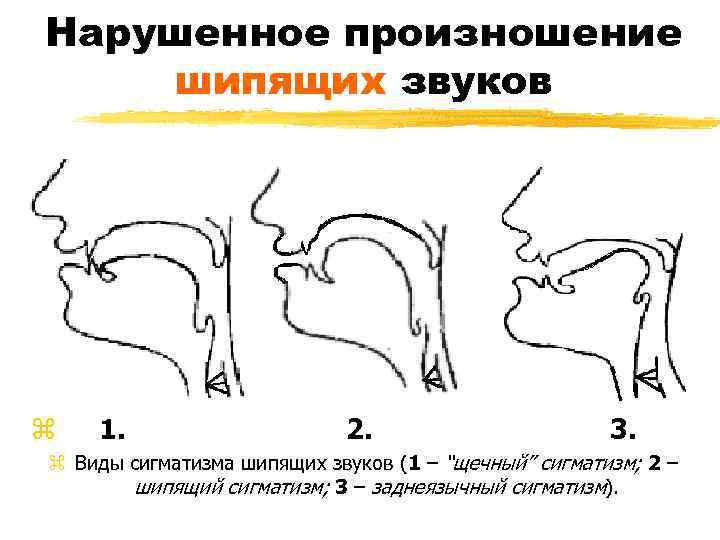 Нарушенное произношение шипящих звуков z 1. 2. 3. z Виды сигматизма шипящих звуков (1