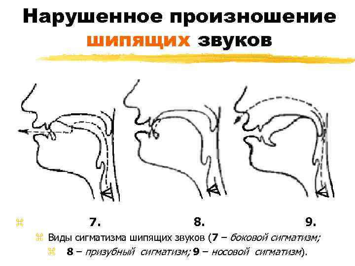 Нарушенное произношение шипящих звуков z 7. 8. 9. z Виды сигматизма шипящих звуков (7