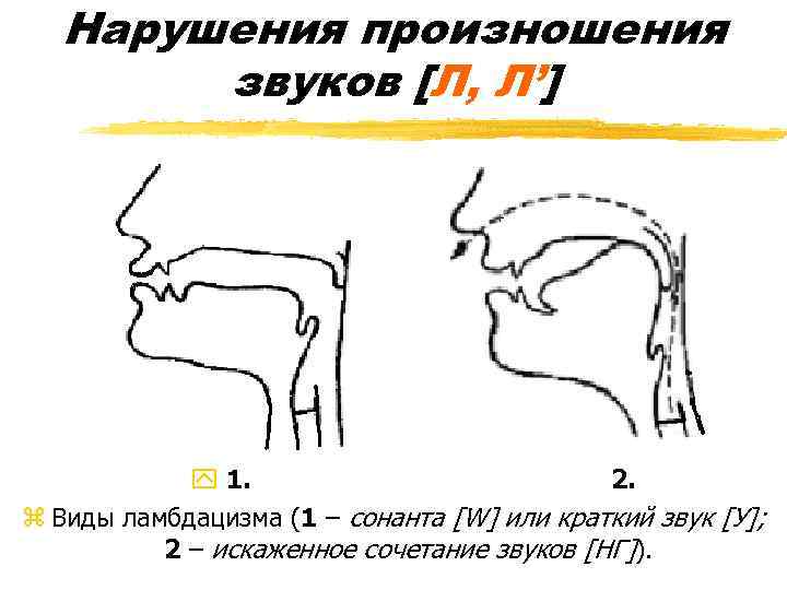 Нарушения произношения звуков [Л, Л’] y 1. 2. z Виды ламбдацизма (1 – сонанта