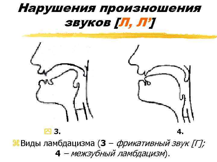 Нарушения произношения звуков [Л, Л’] y 3. 4. z Виды ламбдацизма (3 – фрикативный