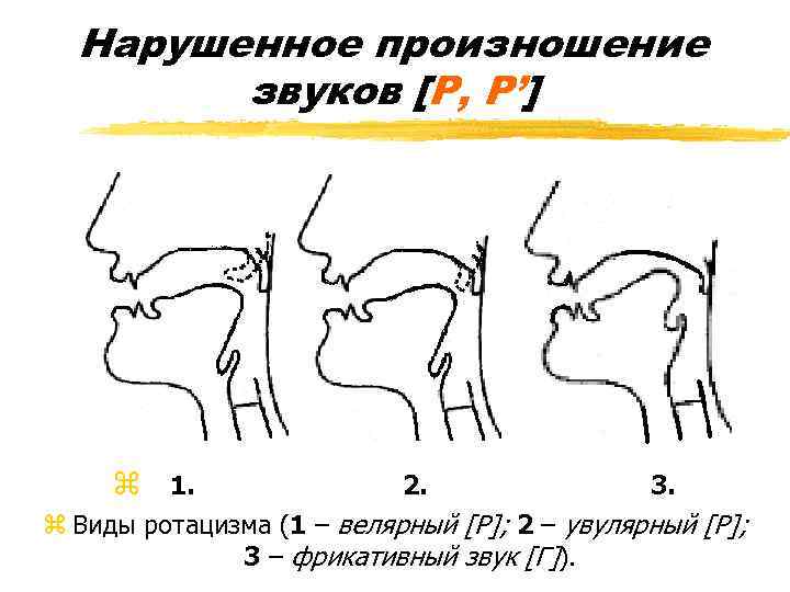 Нарушенное произношение звуков [Р, Р’] z 1. 2. 3. z Виды ротацизма (1 –