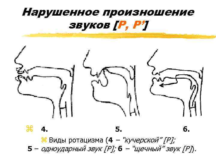 Нарушенное произношение звуков [Р, Р’] z 4. 5. 6. z Виды ротацизма (4 –