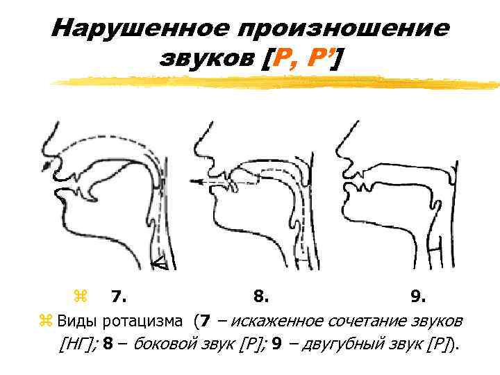 Нарушенное произношение звуков [Р, Р’] z 7. 8. 9. z Виды ротацизма (7 –