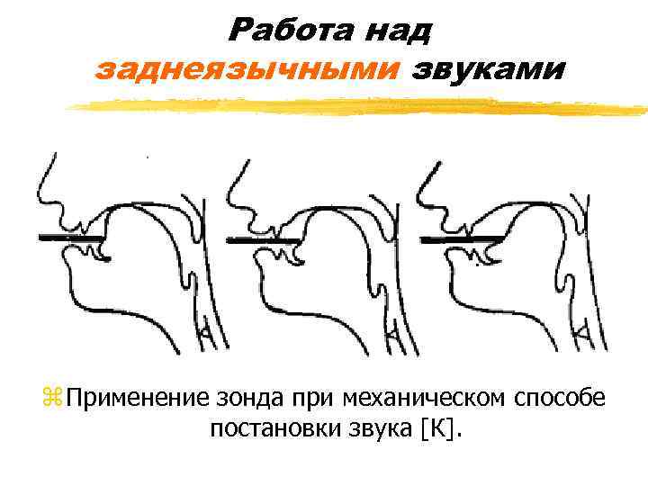 Работа над заднеязычными звуками z Применение зонда при механическом способе постановки звука [К]. 