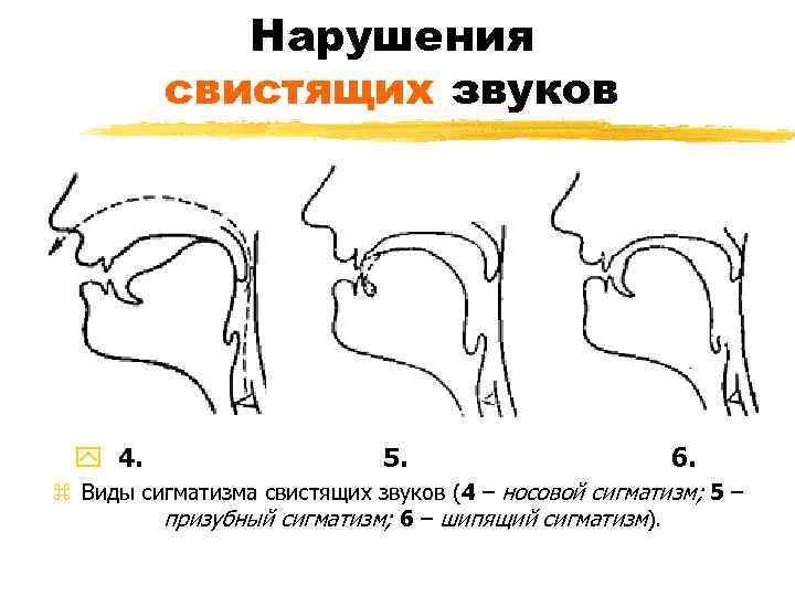 Нарушения свистящих звуков y 4. 5. 6. z Виды сигматизма свистящих звуков (4 –