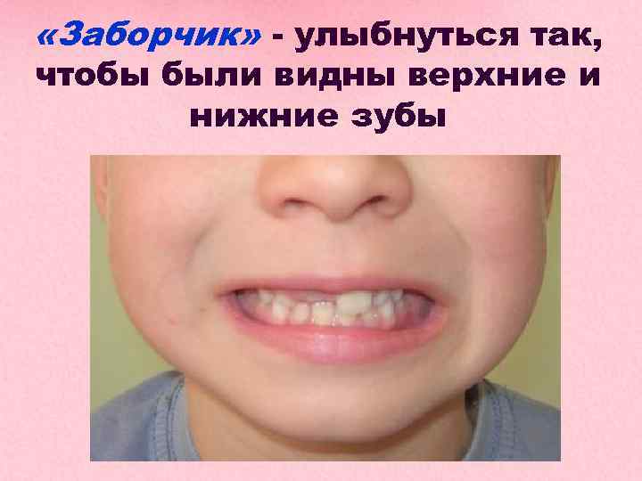  «Заборчик» - улыбнуться так, чтобы были видны верхние и нижние зубы 