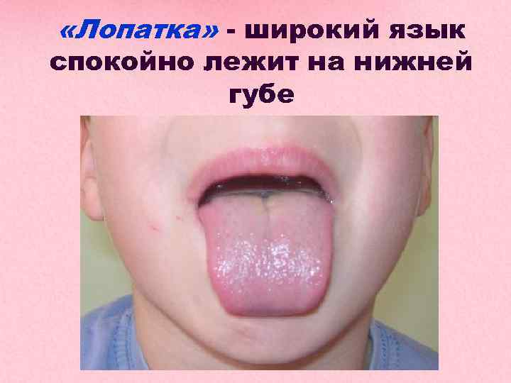  «Лопатка» - широкий язык спокойно лежит на нижней губе 
