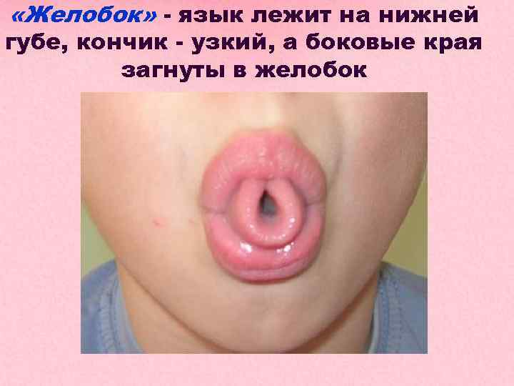 «Желобок» - язык лежит на нижней губе, кончик - узкий, а боковые края