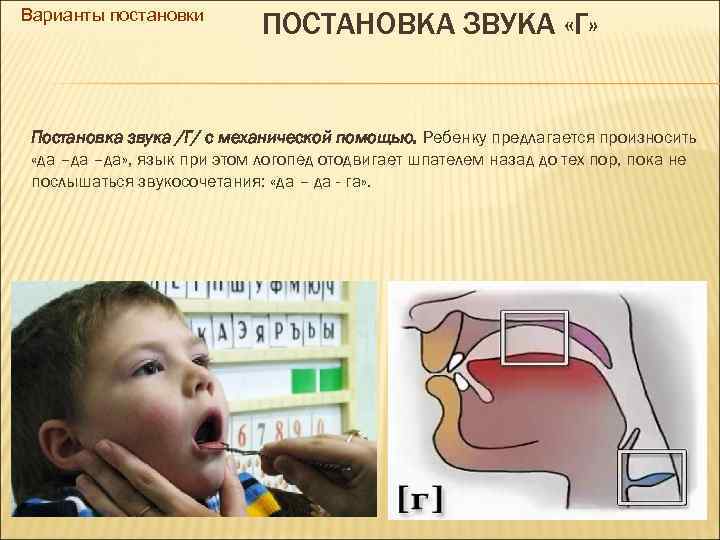 Варианты постановки ПОСТАНОВКА ЗВУКА «Г» Постановка звука /Г/ с механической помощью. Ребенку предлагается произносить
