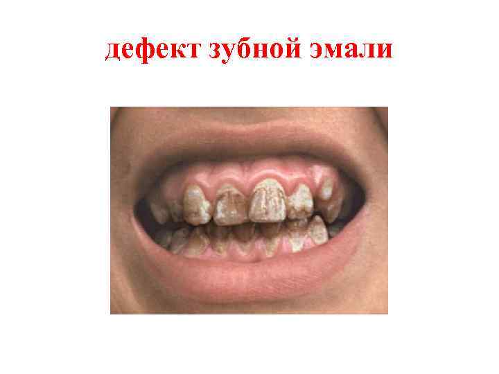 дефект зубной эмали 