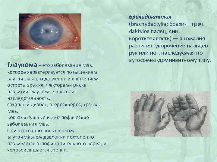 Глаукома – это заболевание глаз, которое характеризуется повышением внутриглазного давления и снижением остроты зрения.