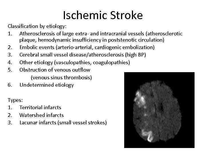 Ischemic Stroke Classification by etiology: 1. Atherosclerosis of large extra- and intracranial vessels (atherosclerotic