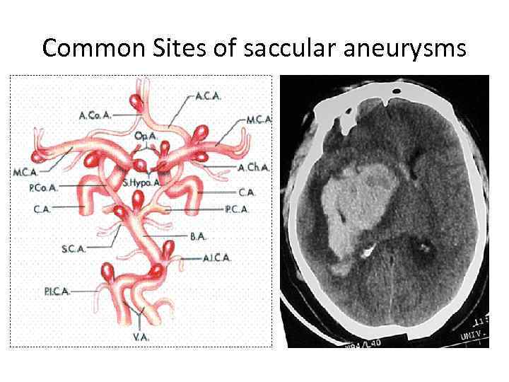 Common Sites of saccular aneurysms 