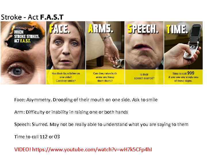 Face: Asymmetry. Drooping of their mouth on one side. Ask to smile Arm: Difficulty