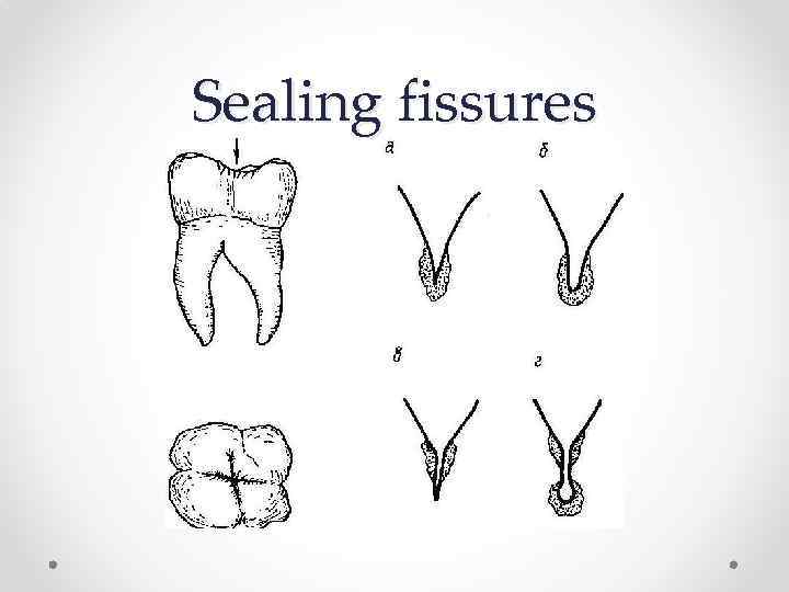 Sealing fissures 