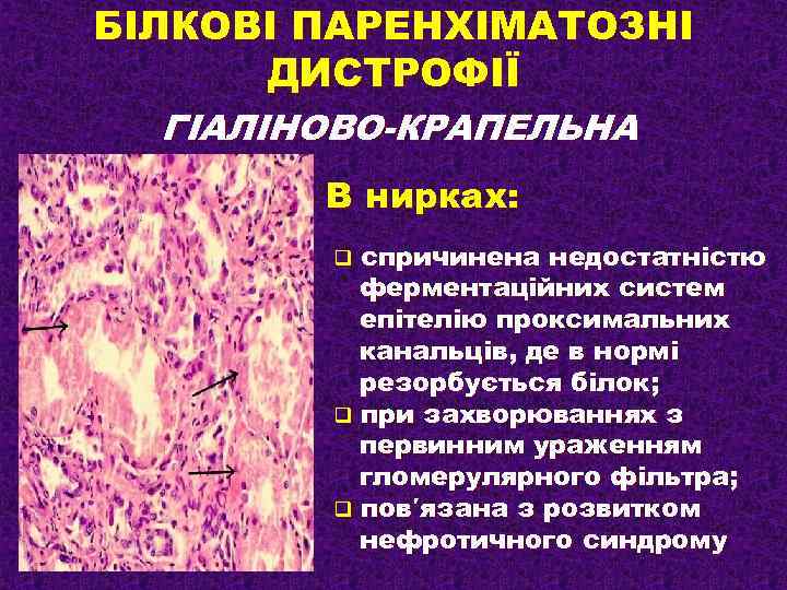 БІЛКОВІ ПАРЕНХІМАТОЗНІ ДИСТРОФІЇ ГІАЛІНОВО-КРАПЕЛЬНА В нирках: спричинена недостатністю ферментаційних систем епітелію проксимальних канальців, де