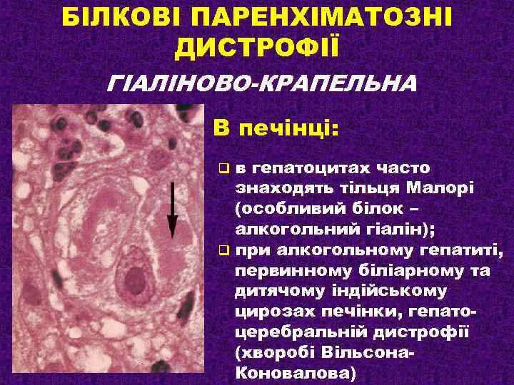 БІЛКОВІ ПАРЕНХІМАТОЗНІ ДИСТРОФІЇ ГІАЛІНОВО-КРАПЕЛЬНА В печінці: в гепатоцитах часто знаходять тільця Малорі (особливий білок