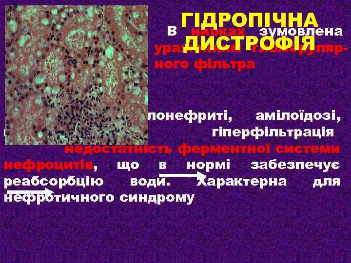 ГІДРОПІЧНА В нирках зумовлена ДИСТРОФІЯ ураженням гломерулярного фільтра (при гломерулонефриті, амілоїдозі, цукровому діабеті) гіперфільтрація