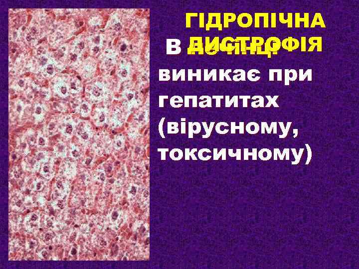 ГІДРОПІЧНА В ДИСТРОФІЯ печінці виникає при гепатитах (вірусному, токсичному) 