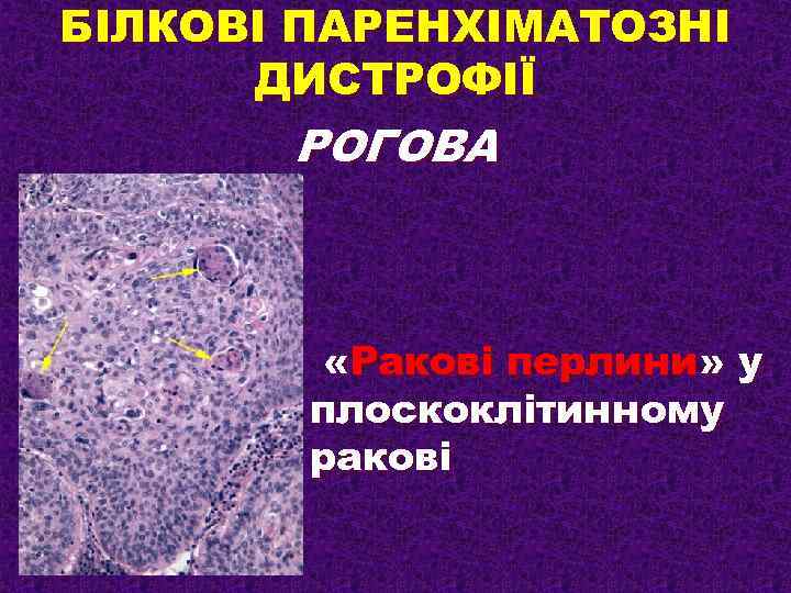 БІЛКОВІ ПАРЕНХІМАТОЗНІ ДИСТРОФІЇ РОГОВА «Ракові перлини» у плоскоклітинному ракові 