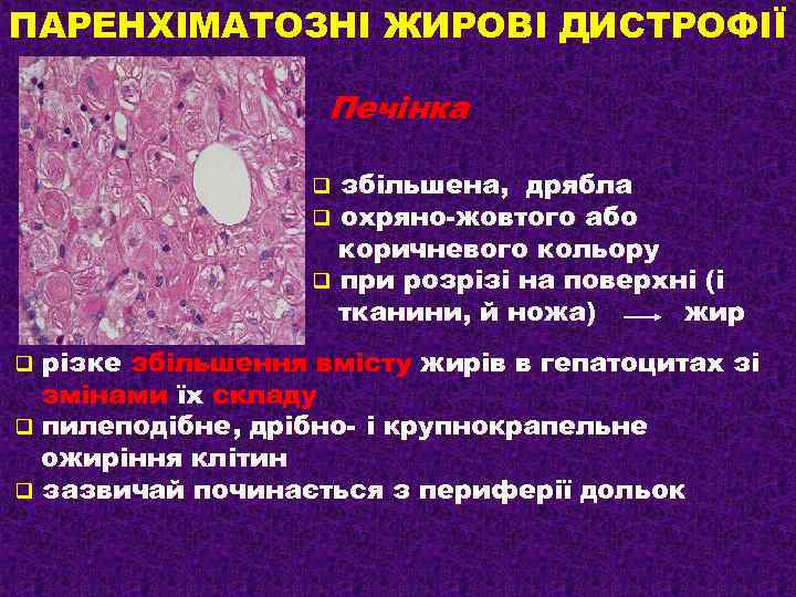 ПАРЕНХІМАТОЗНІ ЖИРОВІ ДИСТРОФІЇ Печінка збільшена, дрябла охряно-жовтого або коричневого кольору q при розрізі на