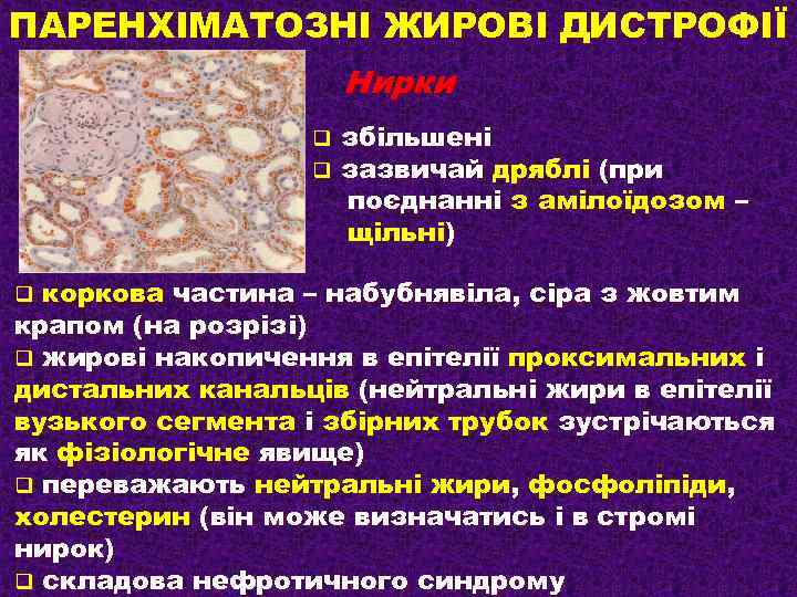 ПАРЕНХІМАТОЗНІ ЖИРОВІ ДИСТРОФІЇ Нирки q q збільшені зазвичай дряблі (при поєднанні з амілоїдозом –