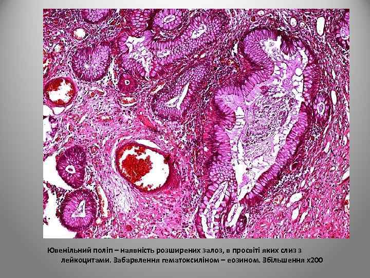 Ювенільний поліп – наявність розширених залоз, в просвіті яких слиз з лейкоцитами. Забарвлення гематоксиліном
