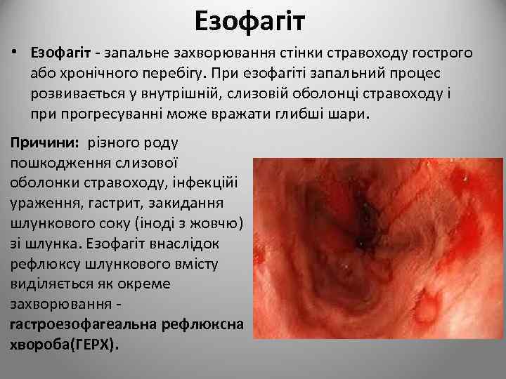 Езофагіт • Езофагіт - запальне захворювання стінки стравоходу гострого або хронічного перебігу. При езофагіті