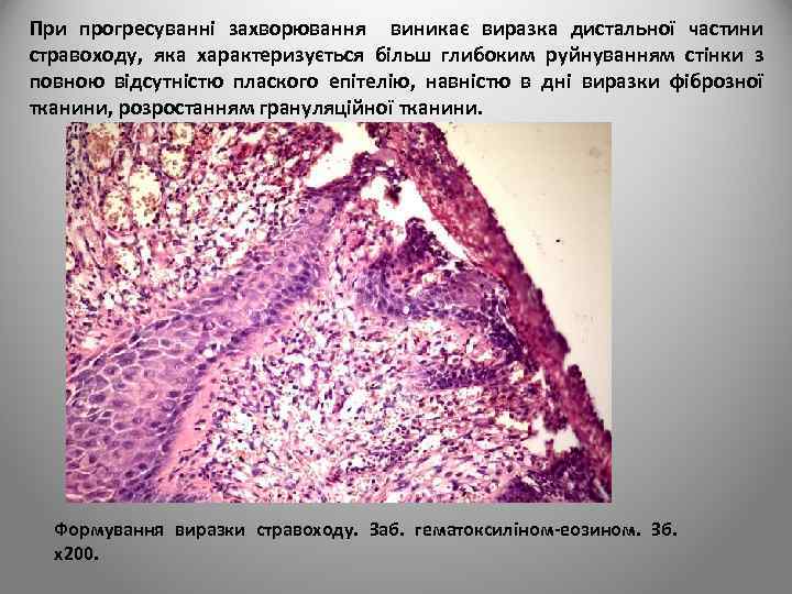 При прогресуванні захворювання виникає виразка дистальної частини стравоходу, яка характеризується більш глибоким руйнуванням стінки