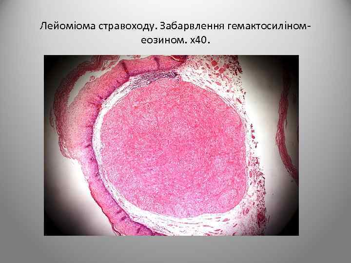 Лейоміома стравоходу. Забарвлення гемактосиліномеозином. х40. 