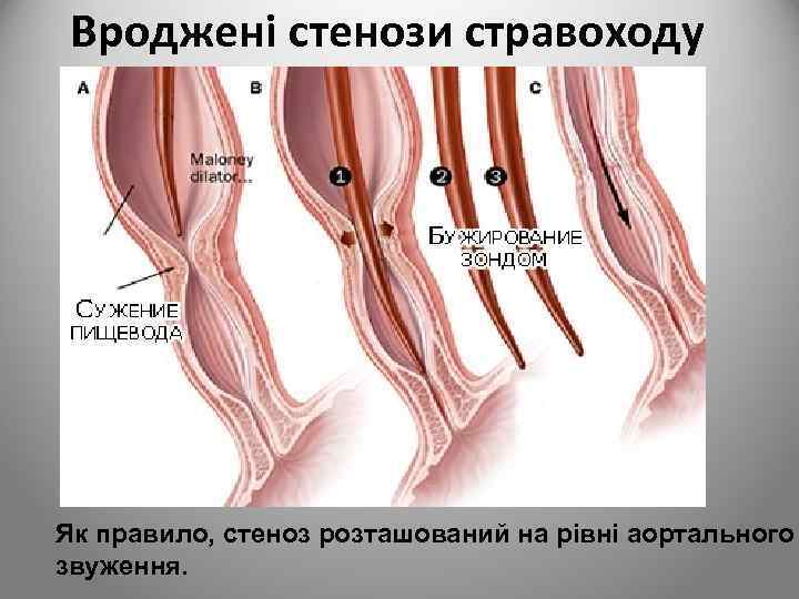 Вроджені стенози стравоходу Як правило, стеноз розташований на рівні аортального звуження. 