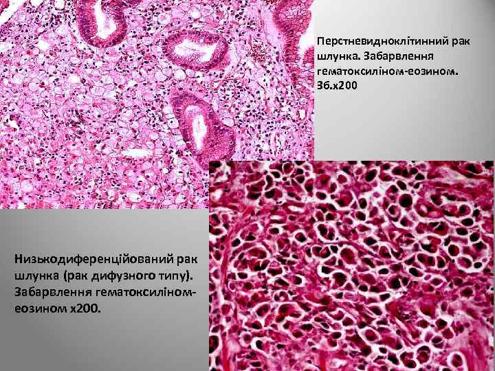 Перстневидноклітинний рак шлунка. Забарвлення гематоксиліном-еозином. Зб. х200 Низькодиференційований рак шлунка (рак дифузного типу). Забарвлення