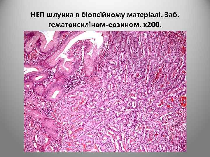 НЕП шлунка в біопсійному матеріалі. Заб. гематоксиліном-еозином. х200. 