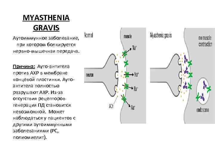 MYASTHENIA GRAVIS Аутоиммунное заболевание, при котором болкируется нервно-мышечная передача. Причина: Ауто-антитела против АХР в