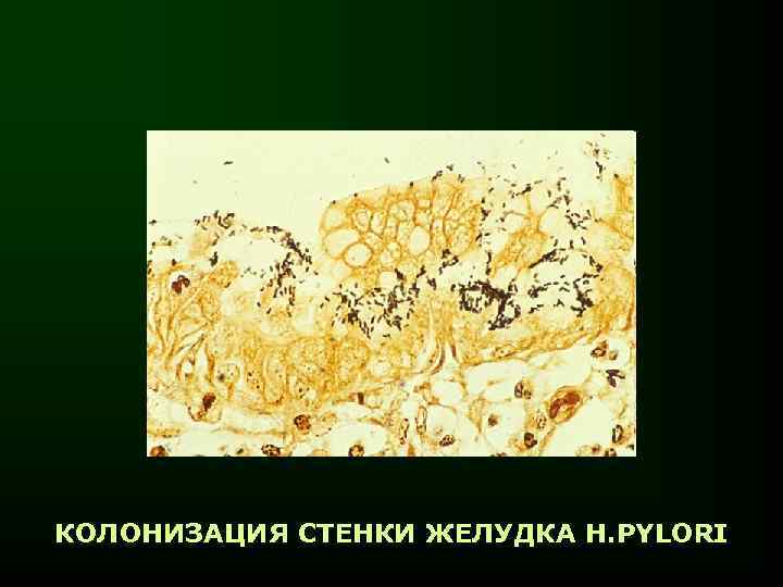 КОЛОНИЗАЦИЯ СТЕНКИ ЖЕЛУДКА H. PYLORI 