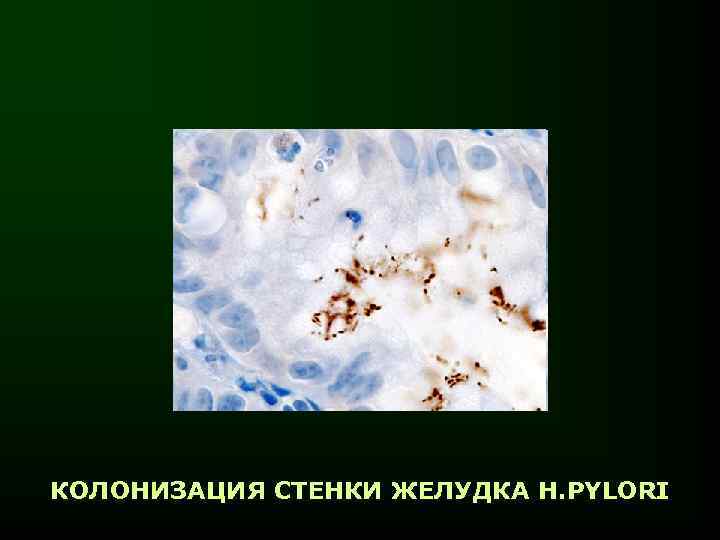 КОЛОНИЗАЦИЯ СТЕНКИ ЖЕЛУДКА H. PYLORI 