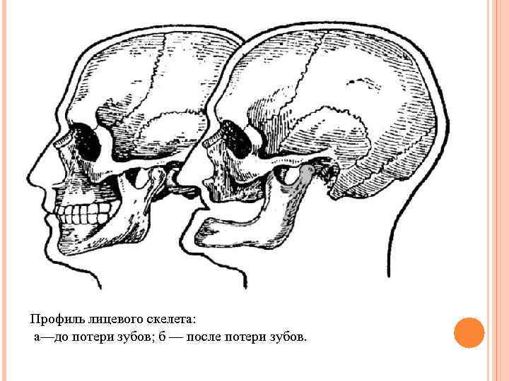 Профиль лицевого скелета: а—до потери зубов; б — после потери зубов. 