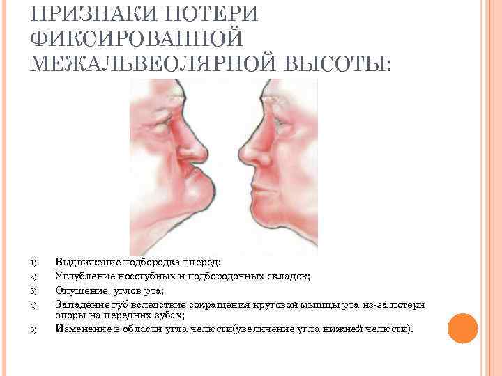 Опущение угла рта. Признаки потери межальвеолярной высоты. Изменение нижней трети лица. Западение верхней губы. Потеря фиксированной межальвеолярной высоты.