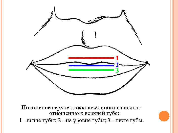 Верхний край губы. Установление высоты верхнего окклюзионного валика. Центральное соотношение челюстей. Положение верхней губы. Определение центрального соотношения челюстей.