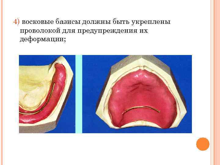 4) восковые базисы должны быть укреплены проволокой для предупреждения их деформации; 